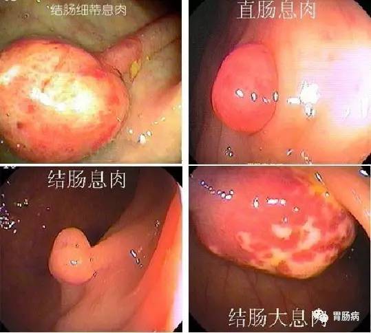 直肠癌是腺瘤引起的吗,结直肠癌都是息肉引起的吗