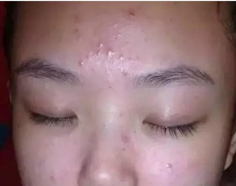 糟心的痘痘,闭合粉刺反反复复怎么办