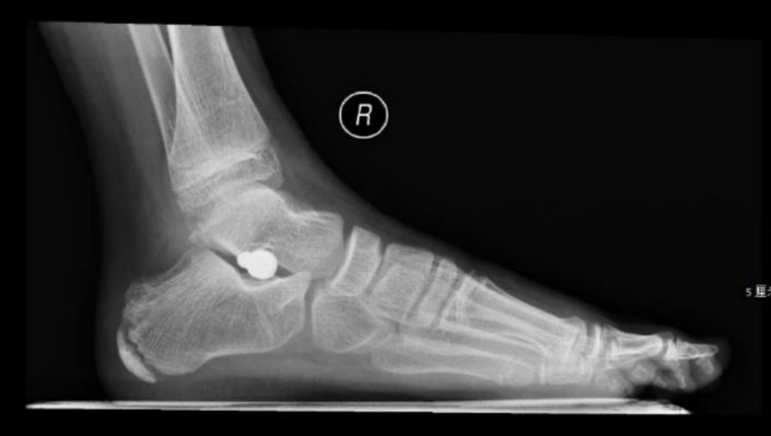 检查孩子脚部发育,怎么检查孩子的脚有没有问题