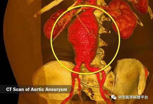 高血压停药的危害,高血压的危害视频