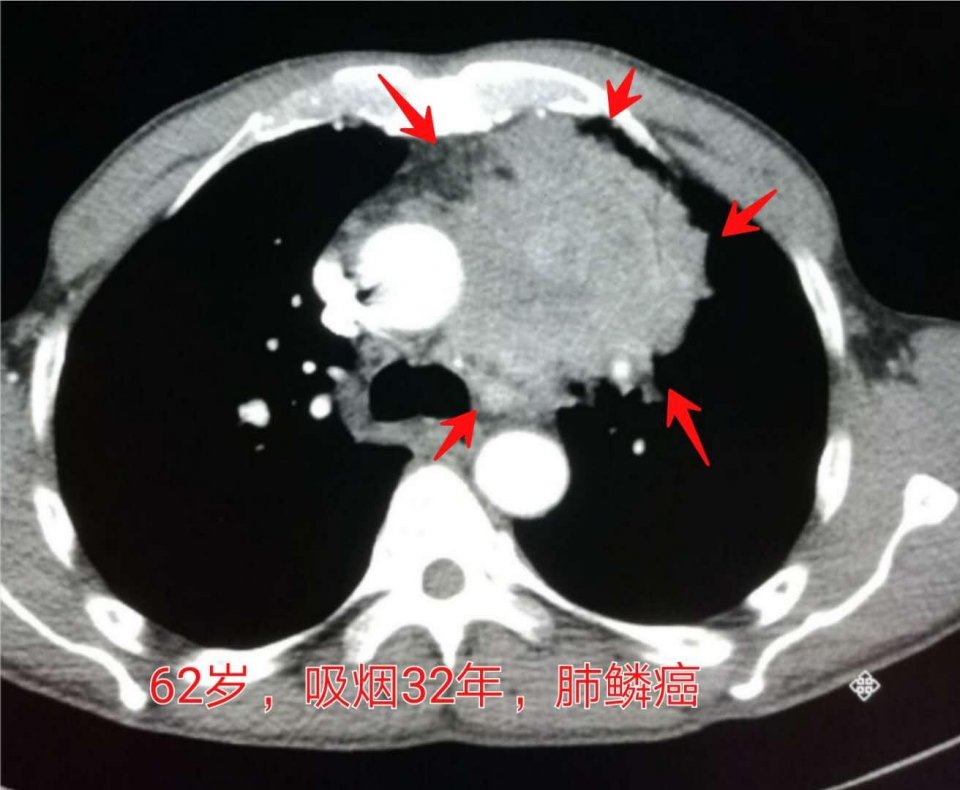 吸烟有害为什么有人能活到90多岁,为什么有的人吸烟寿命更长