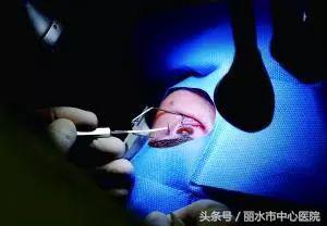 医生几十年经验总结,激光治疗分享