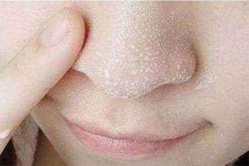鼻子有个黑点挤出来黄色颗粒,鼻子周围长白色的小米粒