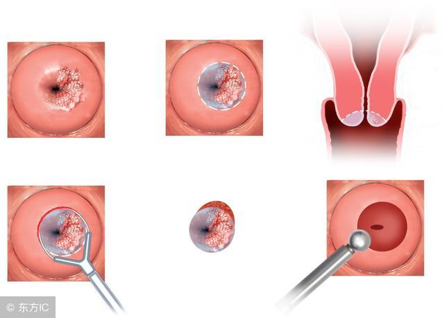 宫颈囊肿糜烂肥大影响怀孕吗,宫颈肥大影响排小便吗