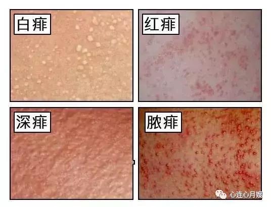 痱子和湿疹怎么区别,痱子和湿疹摸起来有什么区别