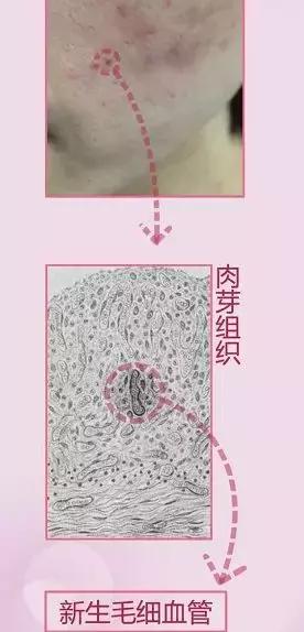 和痘印拜拜30天,跟青春痘说拜拜