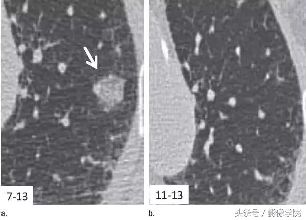 肺结节14种影像,一百例有结果的肺结节影像分析