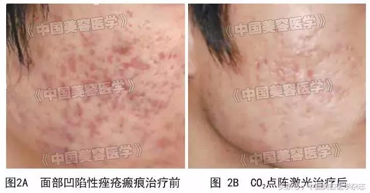 点阵激光打凹陷性疤痕,点阵激光治疗瘢痕疙瘩的效果