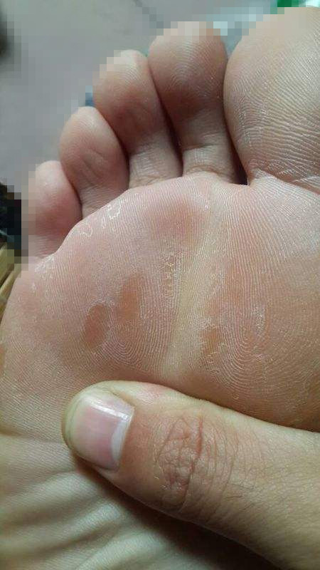 脚臭脱皮不痒是脚气吗,脚气老不好和脾有关系吗