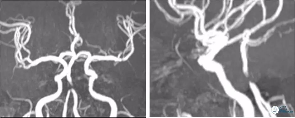 天坛周记｜左椎动脉开口及基底动脉串联狭窄血管内介入治疗1例