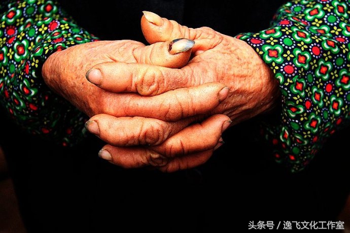 手上无缘无故出血泡,手上的血泡怎么处理