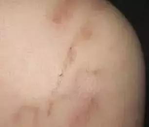 25岁女子脑里有寄生虫,深圳一位20岁女孩大脑长了寄生虫