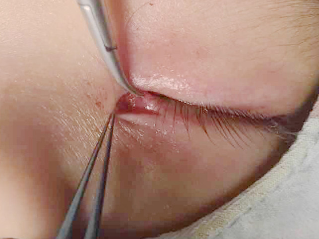 7个月宝宝眼睛被划了一下有事吗,宝宝眼睛被划了一下流泪