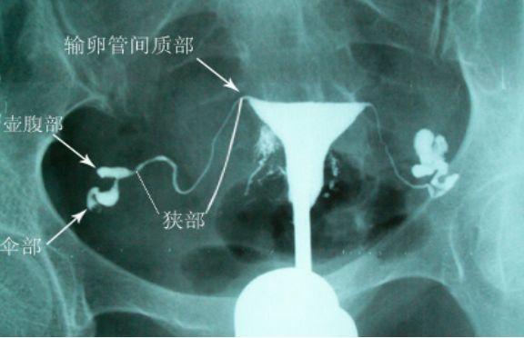 输卵管堵塞介入治疗法是怎么回事,输卵管堵塞介入治疗