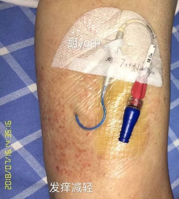 picc皮疹处理,picc湿疹的护理措施