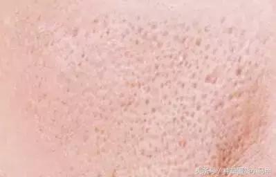 毛孔大和遗传有关系吗,脸出油有没有遗传关系