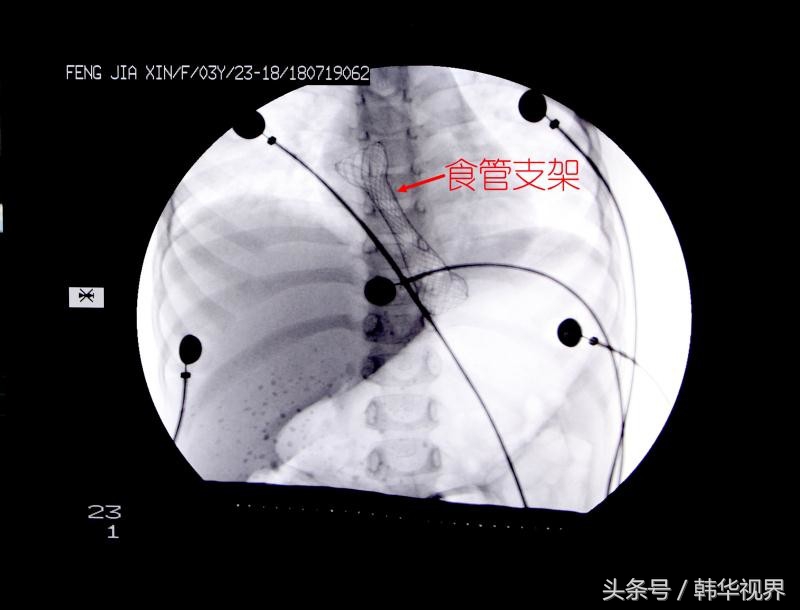 3岁女童把烧碱当白糖灼伤消化道专家妙手回春恢复正常进食