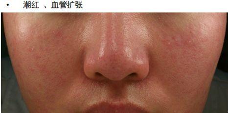 敏感性皮肤用什么化妆品好,敏感性皮肤的特征是什么