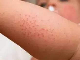 宝宝身上一大片的包是怎么回事,宝宝身上好多片包