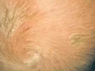 六个月宝宝湿疹皮肤破溃,宝宝起红疹破皮水泡