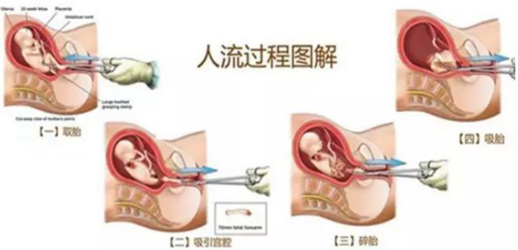 女人一生可以做几次人流,一般女性正常可以做几次人流