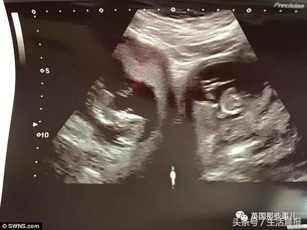 天生一对怀二胎女儿,天生2个子宫是双胞胎吗