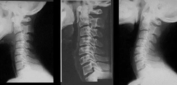 胸闷耳鸣失眠是哪种颈椎病,颈椎病会引起头晕胸闷恶心吗