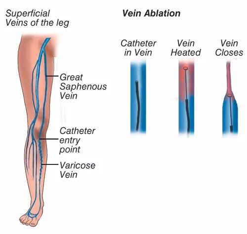 跷二郎腿有什么危害腿粗,跷二郎腿有什么危害图片