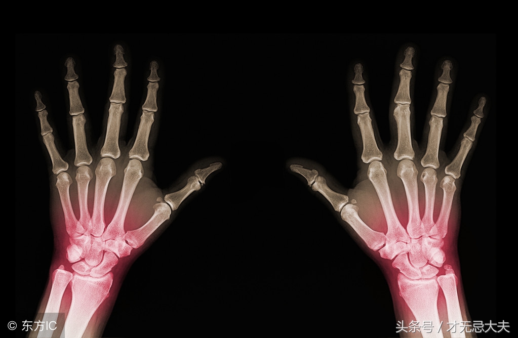 类风湿性关节炎的预防和治疗方法,类风湿性关节炎怎么治疗好得快