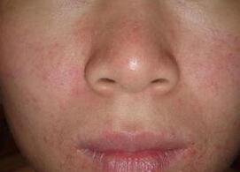 防过敏膏药怎么贴,防过敏贴的使用方法