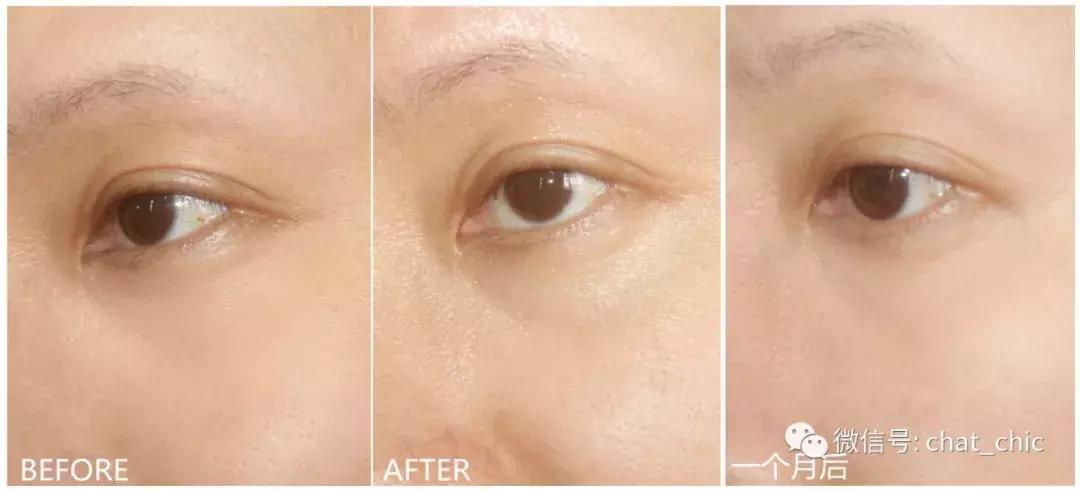 出现第一条鱼尾纹该怎么预防,鱼尾纹是怎么来的