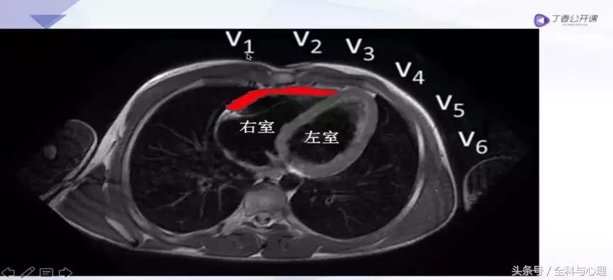 一文读懂心血管疾病,左室心梗和右室心梗