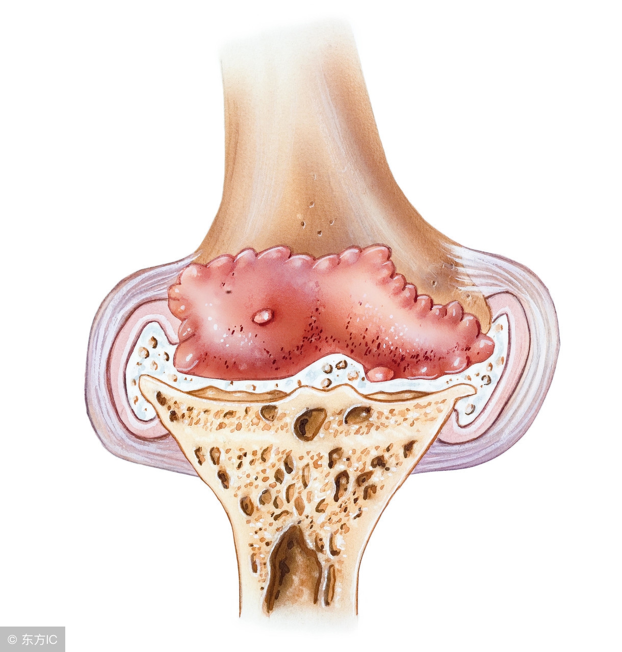 有了骨刺膏药能好吗,得了骨刺调理后疼痛会永远消失吗