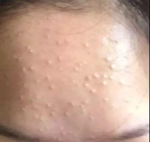 长闭口烦恼,反复长闭口的正确消除方法