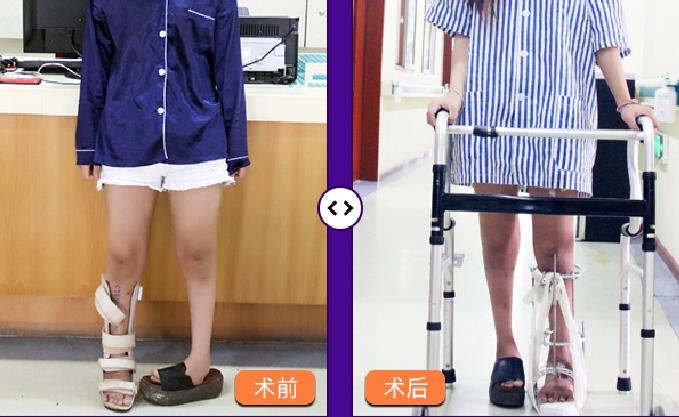 手足畸形矫正,手足畸形精准治疗