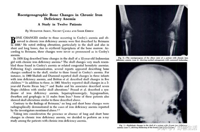 大脑退化不一定会脑萎缩,大脑贫血会有什么状况