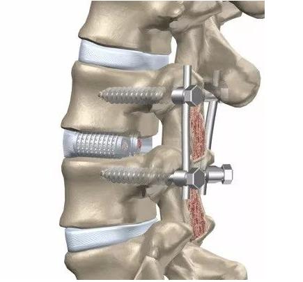 脊柱手术打入4个钉子多久能活动,脊柱手术打19个钢钉
