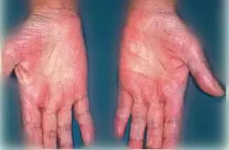 健康手掌颜色,手掌健康颜色