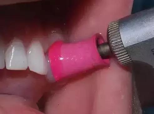 牙齿上的黑点污垢怎么能够清理掉,孩子牙齿上有黑色的斑怎么去除