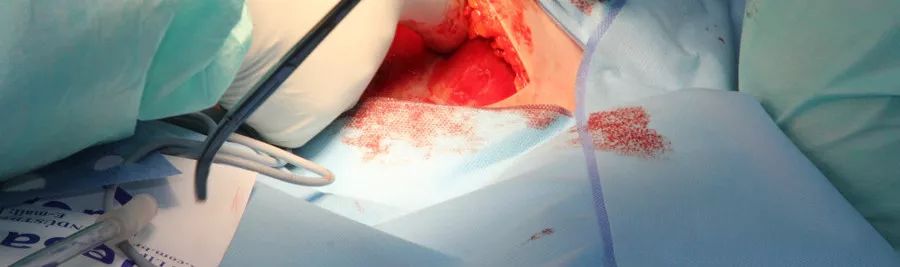 癌症病人发烧到38-39度是怎么回事,癌症病人发烧是不是癌细胞扩散了