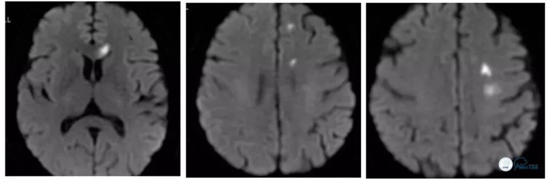 天坛医院住院日记,颈内动脉c5到c7段狭窄微创手术