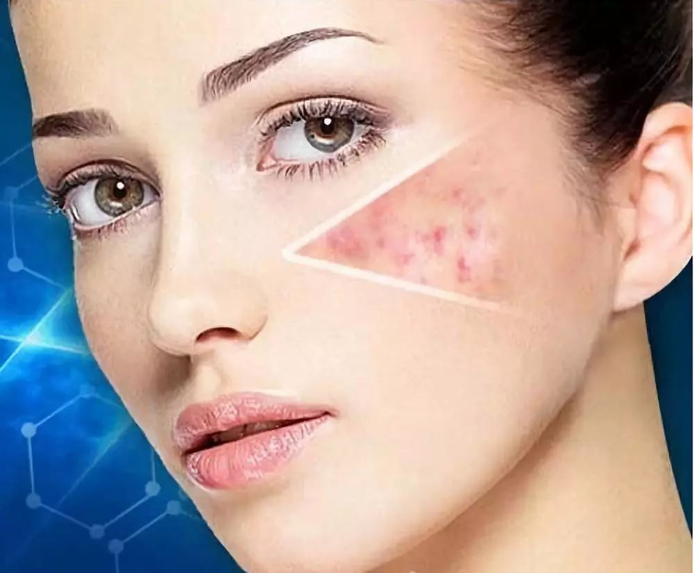 青春痘疤痕消除的药膏,青春痘疤痕图