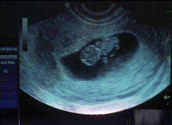 流产后多久才可以生娃,流产次数多了对女人造成什么伤害