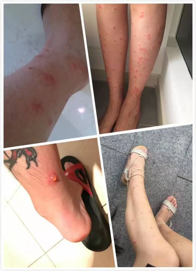 蚊子包怎么快速消红点,如何快速消灭蚊子包