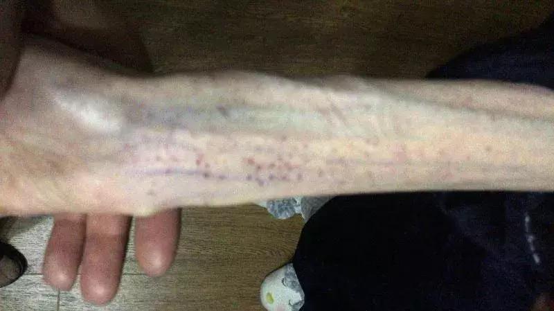 身高1.67米，体重50斤，21岁女孩“自杀式减肥”，医生：她还活着就是一个奇迹