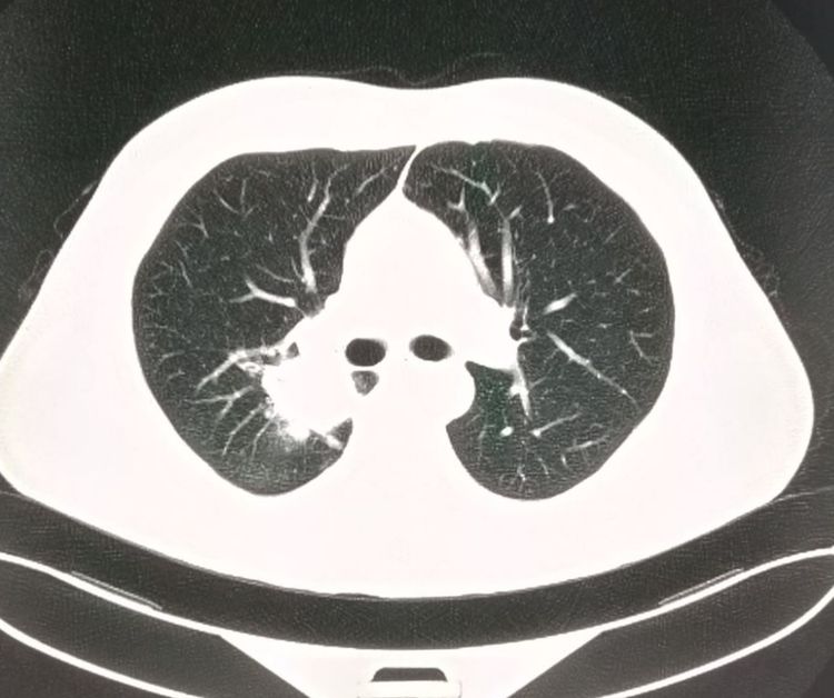 年轻人切除一个肾脏,切除一个肾脏手术全过程