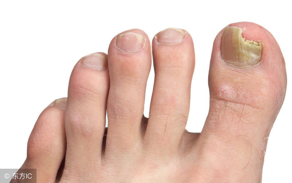 得了灰指甲有什么要注意的,灰指甲怎么看严重程度