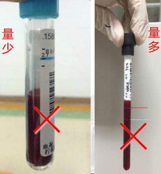 血标本凝结的原因分析,血标本有凝块怎么回事