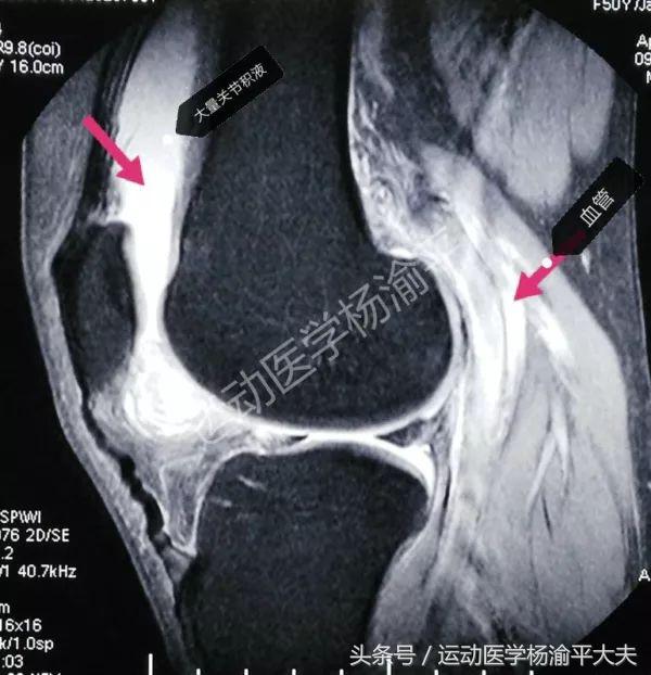 治疗滑膜炎关节积液有奇效,手指关节积液消除最佳方法