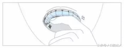 隐形牙套佩戴注意事项,替牙期隐形牙套佩戴管理